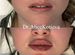 Увеличение губ, косметолог, Профиль Джоли