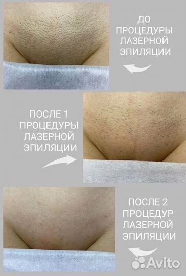 Лазерная эпиляция