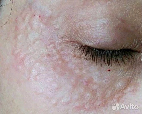 Мезотерапия кожи головы