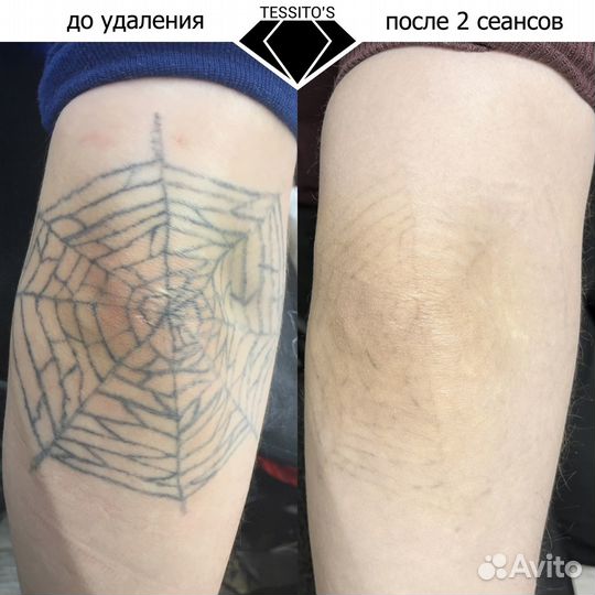 Удаление тату