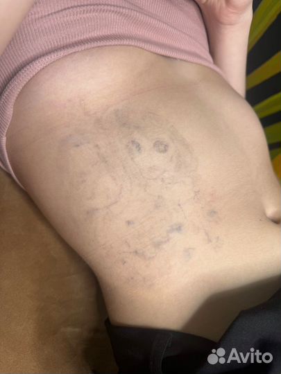 Лазерное удаление татуажа