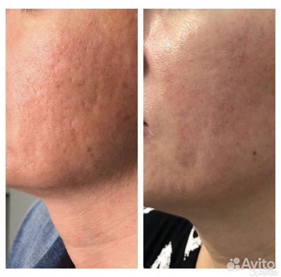 Коррекция шрамов, рубцов (авторская методика)