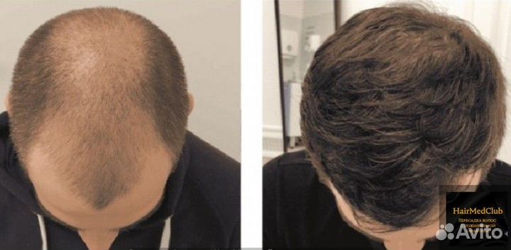 Пересадка волос с пожизненной гарантией