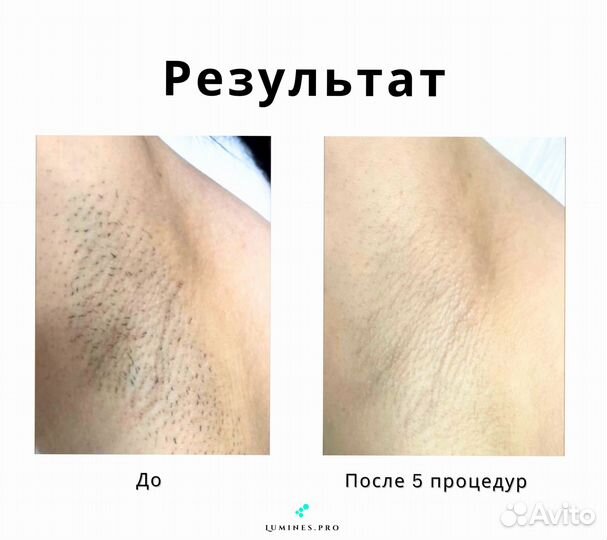 Аппарат для эпиляции люминес максван 1200в