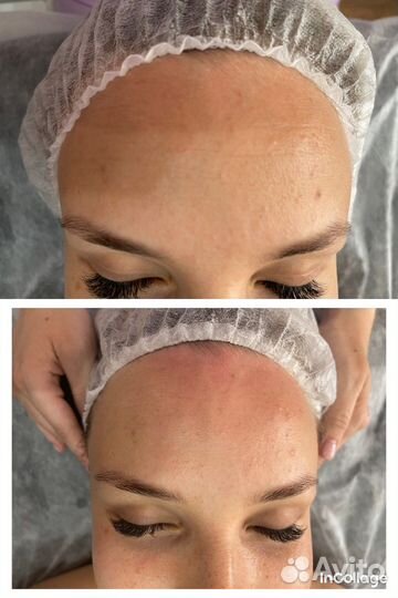 Скульптурно-буккальный массаж лица