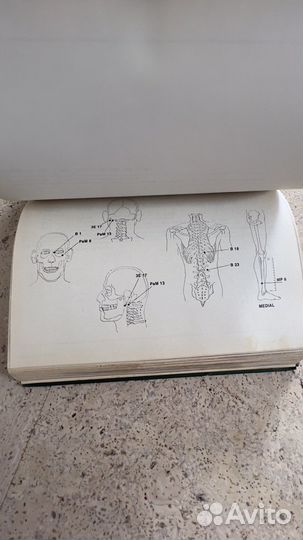 Иглоукалывание