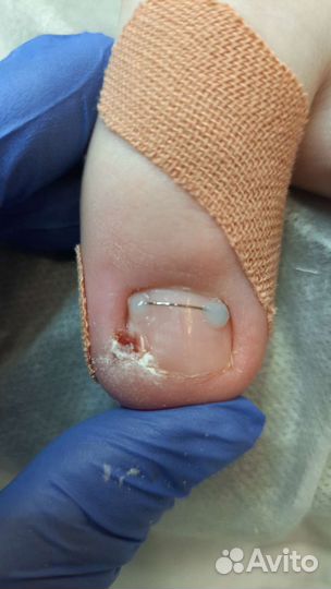 Подология, медицинский педикюр