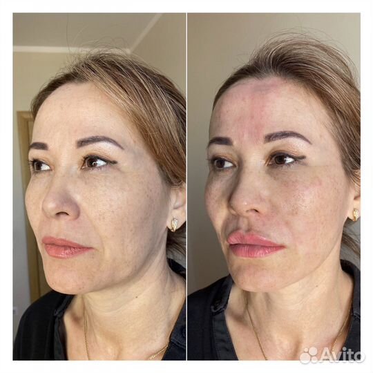 Мезонити,подтяжка лица