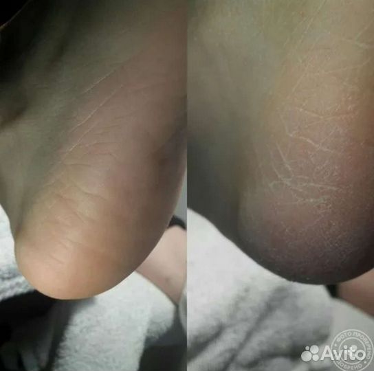 Педикюр с покрытием лаком