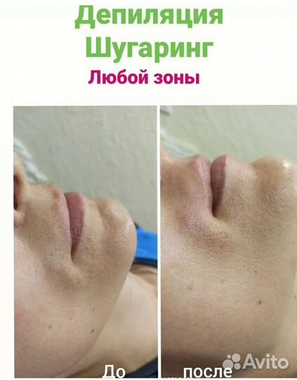 Шугаринг, депиляция
