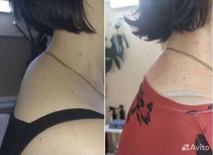 Жиротоп Кавитация, RF лифтинг