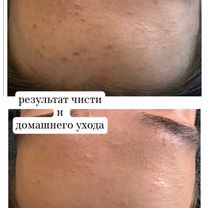 Косметолог чистка лица