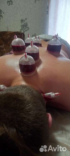 Набор вакуумных банок(хиджама)