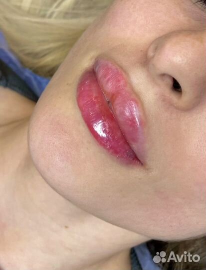 Увеличение губ