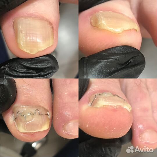 Удаление лечение Вросшего ногтя - Подолог Адлер