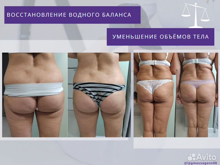 LPG массаж, антицеллюлитный массаж, косметология