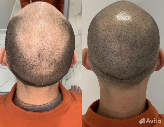 Трихопигментация мужская загущение волос