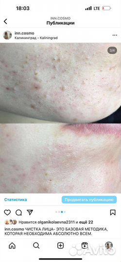 Биоревитализация