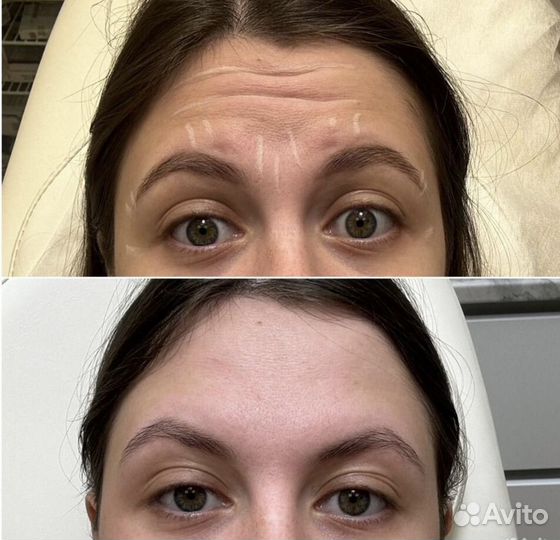 Ботокс (Бутулинотерапия) botox