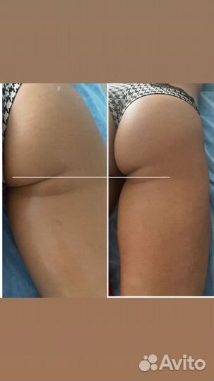 Антицеллюлитный массаж