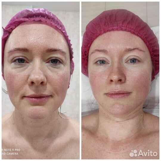 Антицеллюлитный и коррекция фигуры массаж