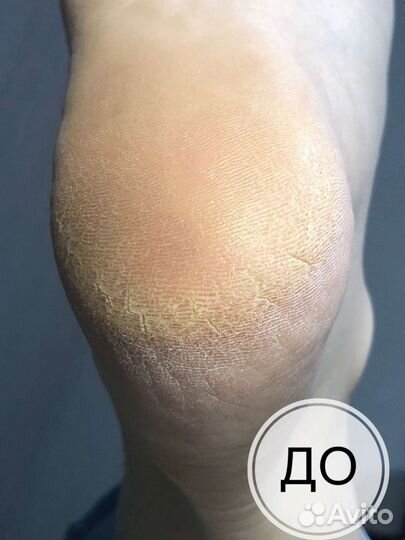 Педикюр аппаратный