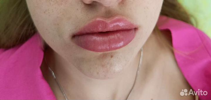 Биоревитализация