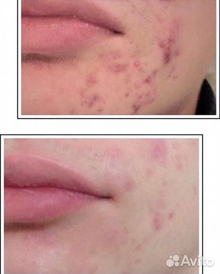 Дерматолог-косметолог, акне, купероза, розацеа