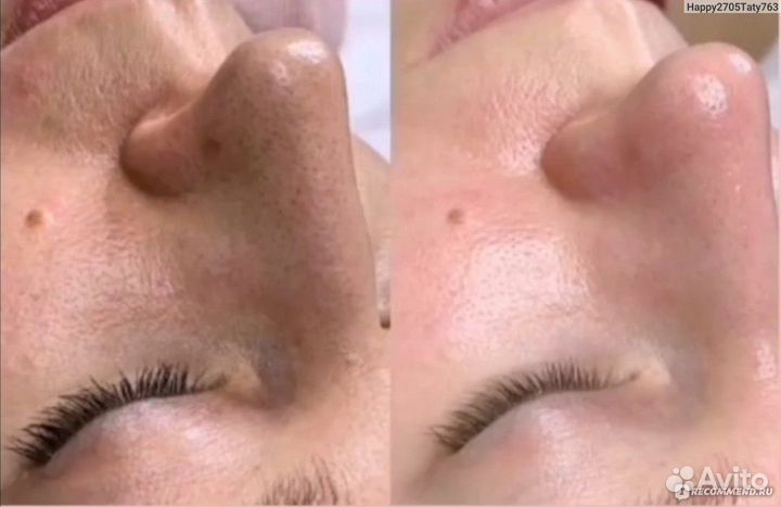 Чистка лица