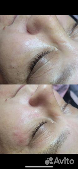 Чистка лица