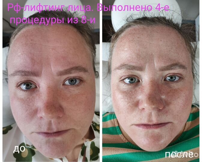 Чистка лица, лифтинг, липосомальный пилинг