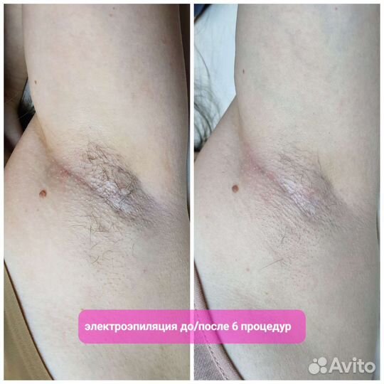 Электроэпиляция