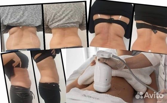 Липосоникс-Безоперационная Липосакция