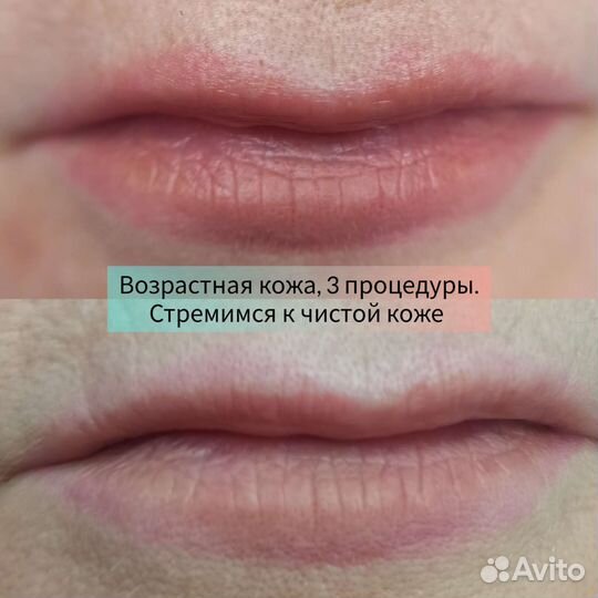 Удаление татуажа и татуировок ремувером