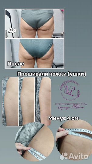 Аппаратная коррекция фигуры