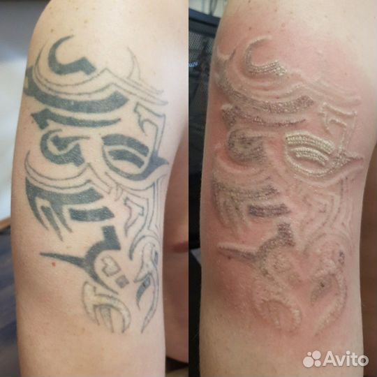 Удаление татуировок и перманентного макияжа