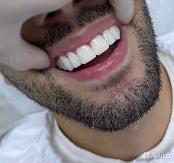 Фотокомпозитные Виниры 5000