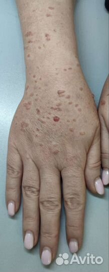 Удаление папиллом, бородавок