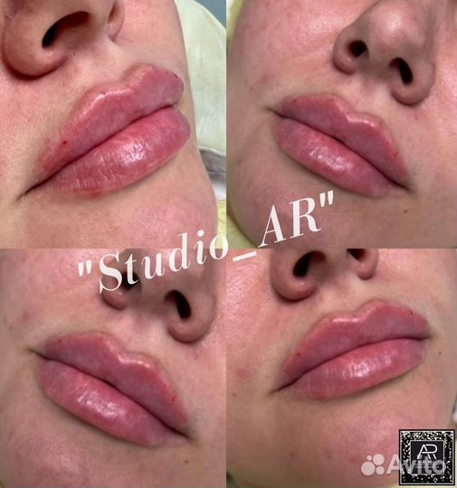 Увеличение губ. Обучение