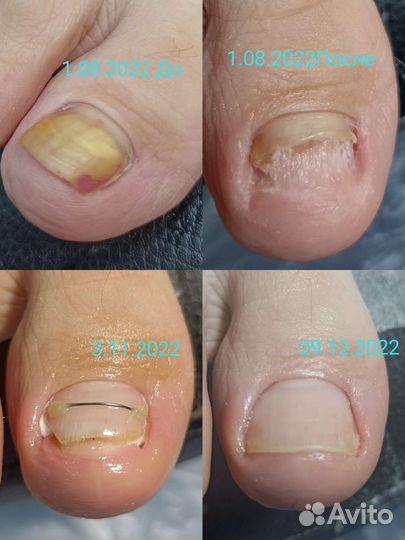 Педикюр.Подолог, установка Титановой нити