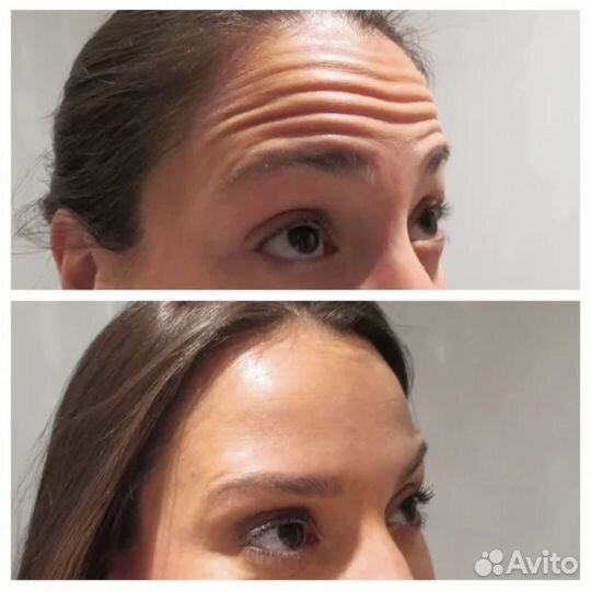 Обучение увеличение губ, ботолутоксин