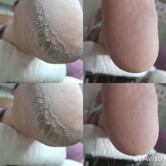 Смарт педикюр