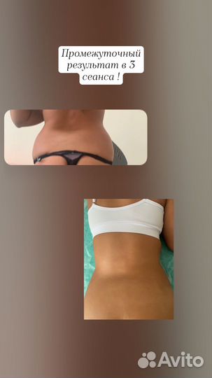 Аппаратный массаж