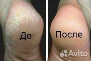 Смарт-пилинг