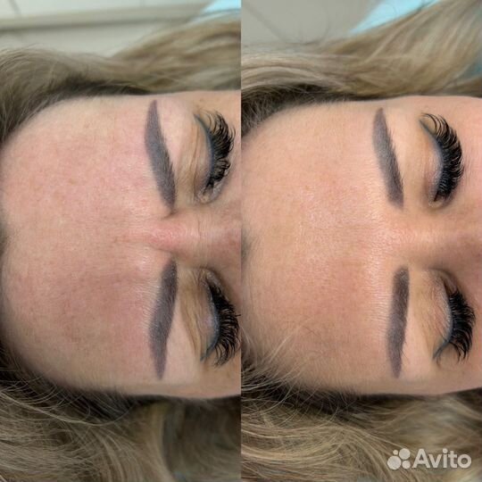 Инъекции ботокса по лицу