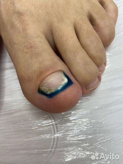 Подолог. Медицинский педикюр