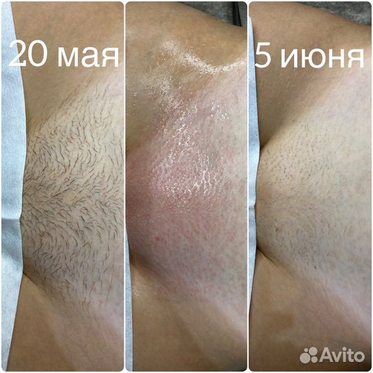 Депиляция воском