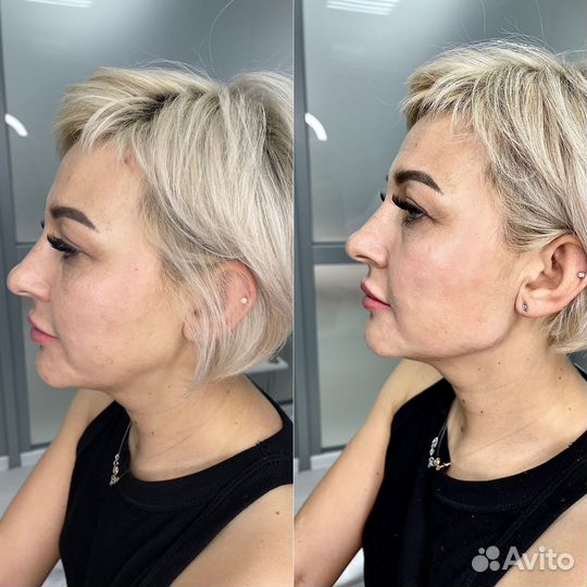 Контурная пластика губ