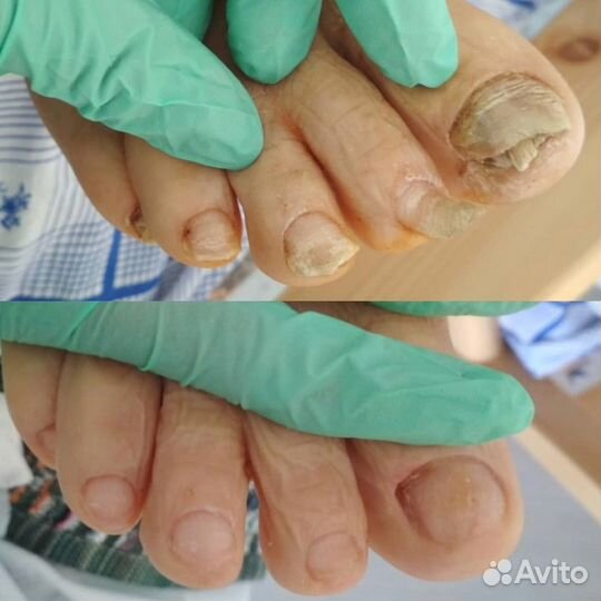 Медицинский Педикюр выезд на дом