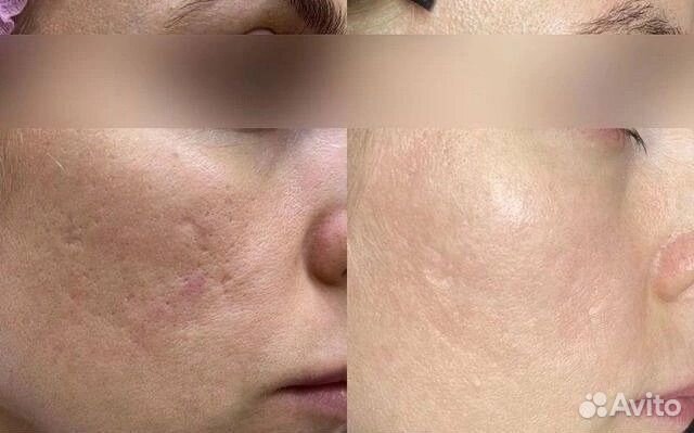 Холодная плазма омоложение лица и тела